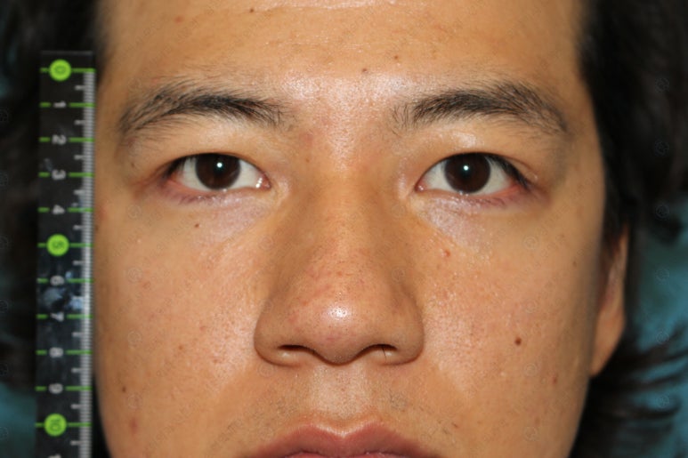 27세 남성 무쌍(속쌍)눈매교정 (27/M Ptosis correction with double lid plasty) 관련 이미지 33