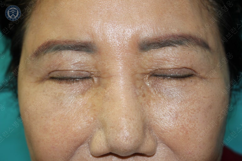71세 여성, 이마거상술과 이마축소술 (71/F, Forehead lift and reduction) 관련 이미지 42