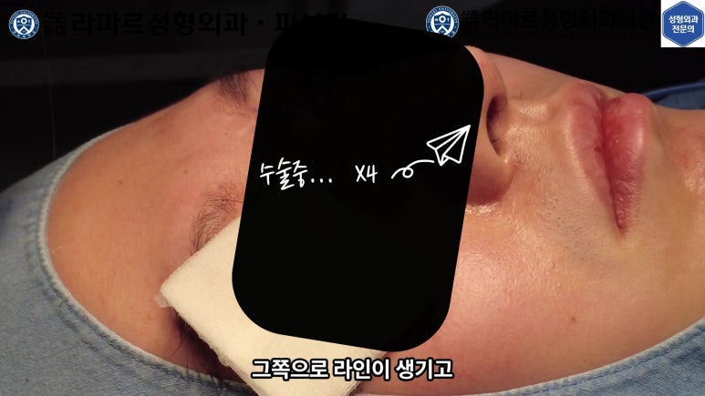 29세 남자, 소시지 쌍꺼풀 두줄따기로 낮추기 (쌍꺼풀 재수술) 관련 이미지 34