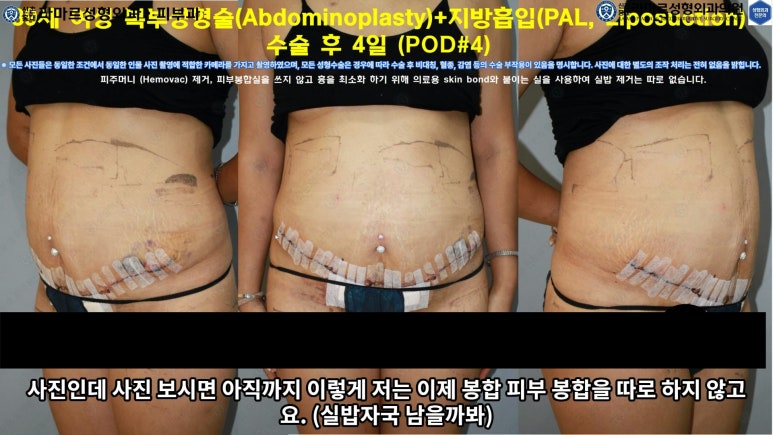 '복부성형술+지방흡입(Abdominoplasty+PAL)' 으로 뱃살 끝장내기! 관련 이미지 42