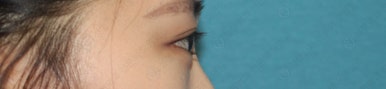 17세 여성, 쌍꺼풀+앞트임(DEO+Medial epicanthoplasty) 관련 이미지 51