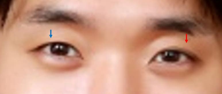 남자눈성형: 무쌍눈매교정 (Blephroptosis correction-levator aponeurosis advancement) 관련 이미지 9