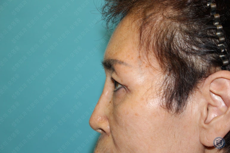64세 여성 상안검성형술+눈매교정 (64/F Upper blepharoplasty with ptosis correction) 관련 이미지 30