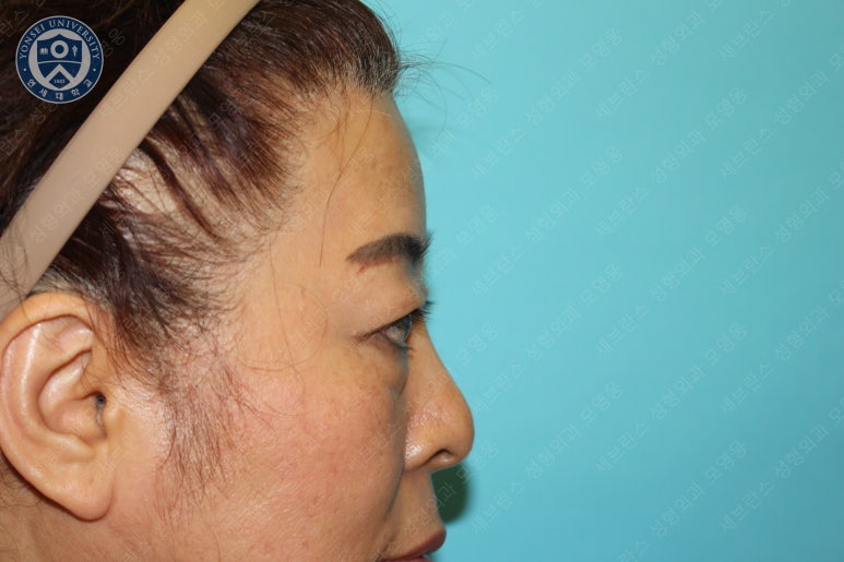 60세 여성, 상안검 및 하안검 성형술 증례 (60/F Upper & lower blepharoplasty) 관련 이미지 9