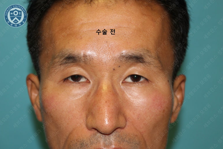 남자눈성형: 무쌍눈매교정 (Blephroptosis correction-levator aponeurosis advancement) 관련 이미지 11