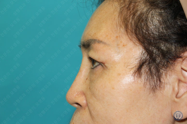 64세 여성 상안검성형술+눈매교정 (64/F Upper blepharoplasty with ptosis correction) 관련 이미지 22