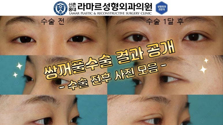 10대~30대 눈 수술 케이스 : 대표원장님 쌍꺼풀 전후 사진 모음 관련 이미지 5