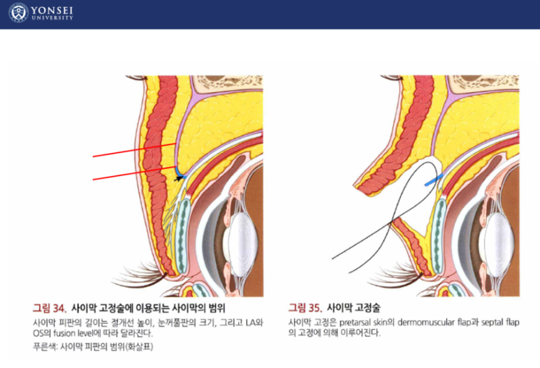 60세 여성, 상안검 및 하안검 성형술 증례 (60/F Upper & lower blepharoplasty) 관련 이미지 11