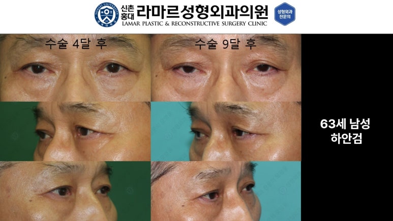 30대~80대 눈 수술 케이스 : 하안검성형술 전후 사진 모음 관련 이미지 22