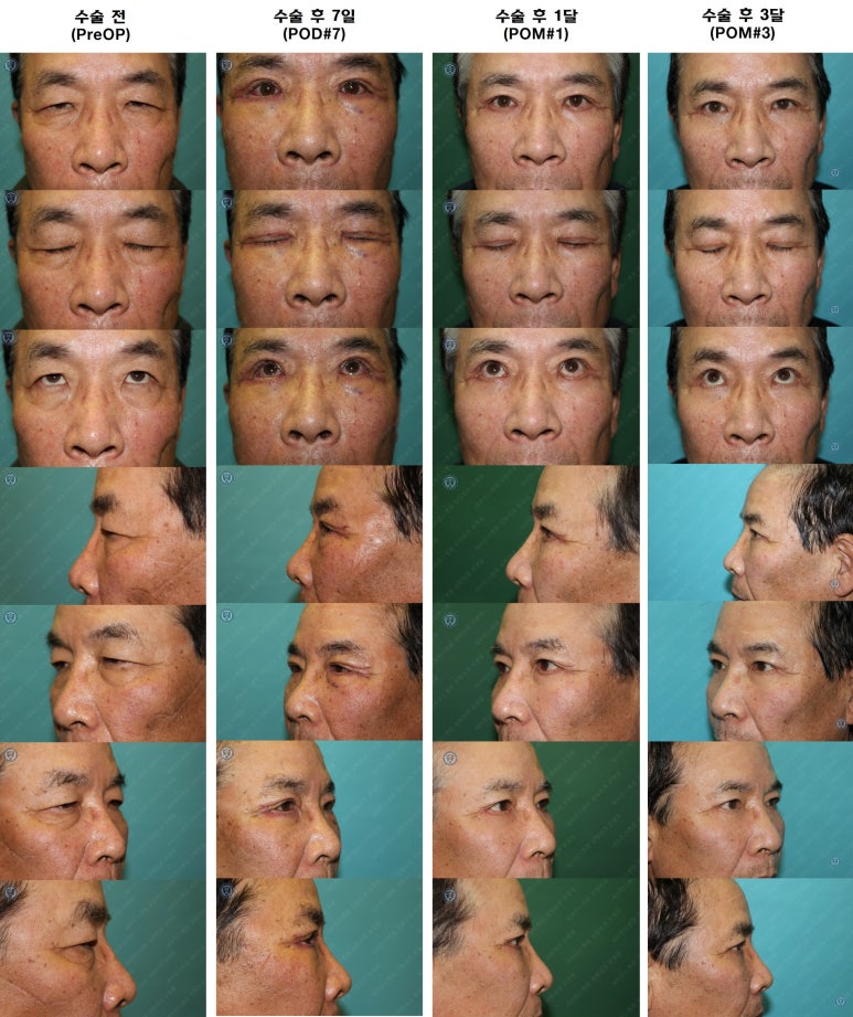 67세 남성, 상&middot;하안검성형술 및 안검하수교정 (67/M, Upper &  lower blepharoplasty with ptosis correction) 관련 이미지 48