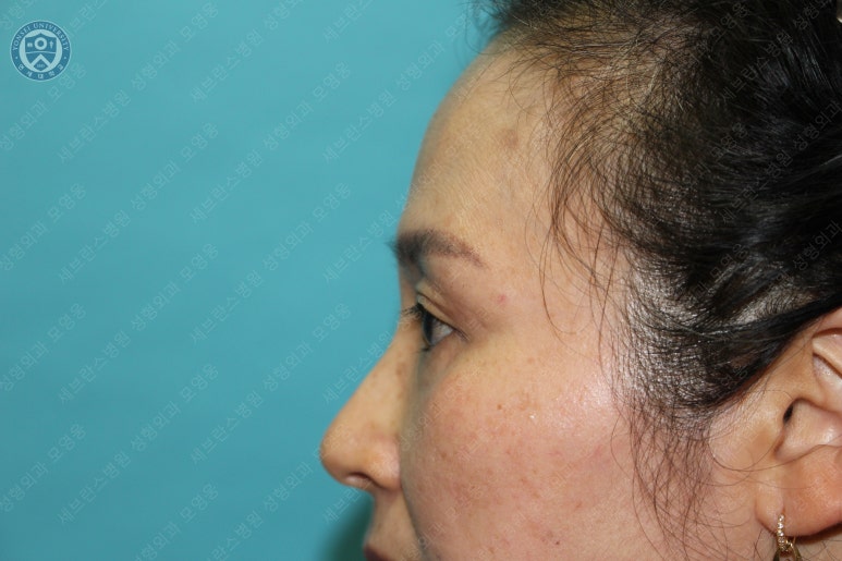 49세 여성, 토안이 있는 중년여성의 상안검성형술 (49/F, Upper blepharoplasty with lagophthalmos correction& LP) 관련 이미지 37