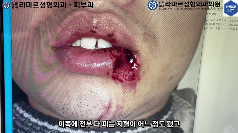 개에 물려 입술 1/3이 뜯긴 19세 남자분 치료 및 흉터 성형수술& 레이저 후기....! 관련 이미지 19