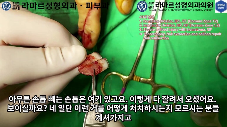 손가락 힘줄 손상 및 열상, 손톱 바닥 열상 처치 (Extensor tendon repair and nailbed injury treatment) 관련 이미지 17