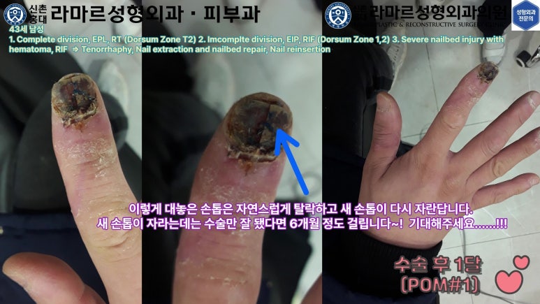 손가락 힘줄 손상 및 열상, 손톱 바닥 열상 처치 (Extensor tendon repair and nailbed injury treatment) 관련 이미지 40
