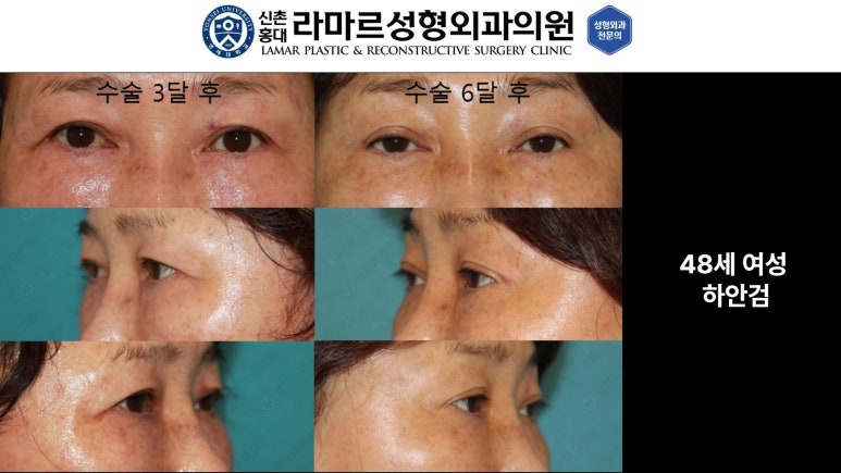 30대~80대 눈 수술 케이스 : 하안검성형술 전후 사진 모음 관련 이미지 8