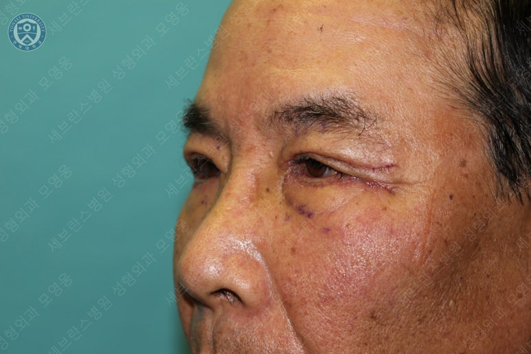 67세 남성, 상&middot;하안검성형술 및 안검하수교정 (67/M, Upper &  lower blepharoplasty with ptosis correction) 관련 이미지 25
