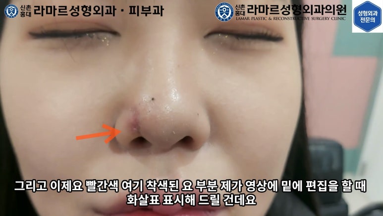 지름 1cm 코 점 제거수술 : 나선피판술(Spiral Flap) 수술전~1달 경과. (Feat. 턱끝필러+사각턱 보톡스) 관련 이미지 158
