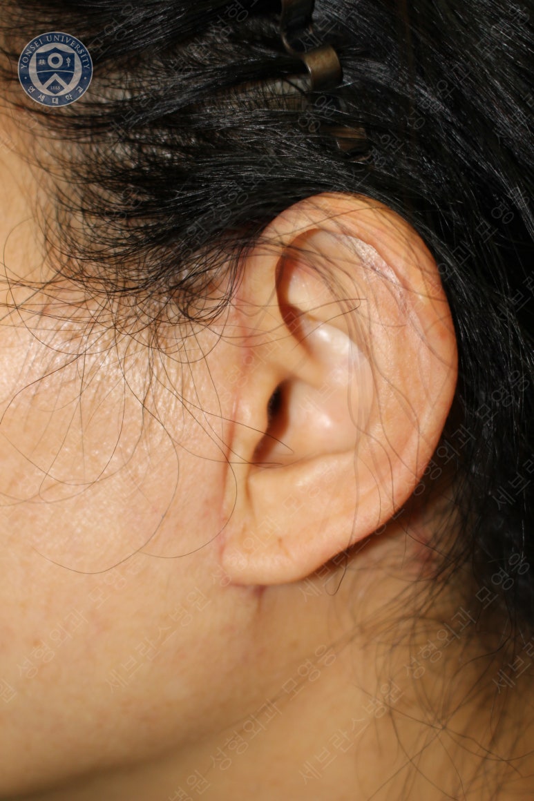 55세 여성, 이중평면 안면거상(55/F, Dual-plane full facelift) 관련 이미지 56
