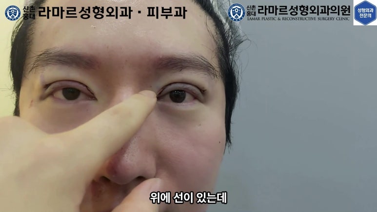 29세 남자, 소시지 쌍꺼풀 두줄따기로 낮추기 (쌍꺼풀 재수술) 관련 이미지 66