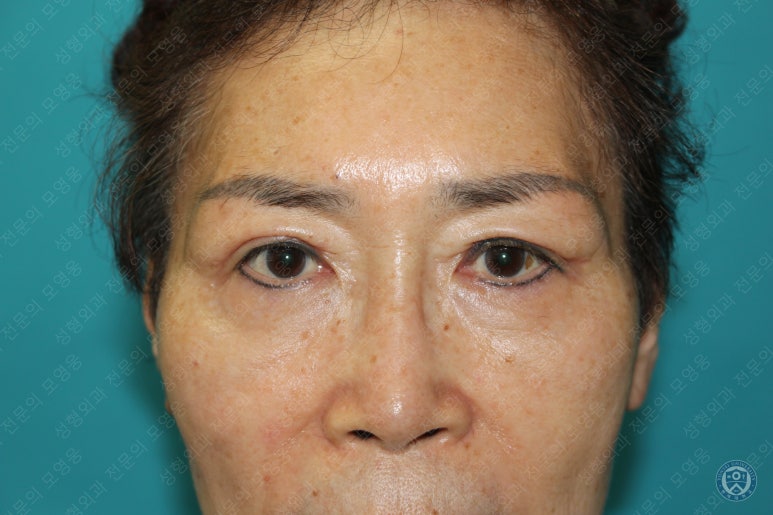 64세 여성 상안검성형술+눈매교정 (64/F Upper blepharoplasty with ptosis correction) 관련 이미지 19