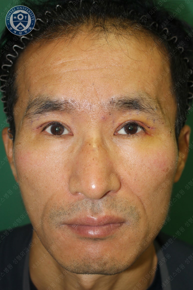 남자눈성형: 무쌍눈매교정 (Blephroptosis correction-levator aponeurosis advancement) 관련 이미지 21