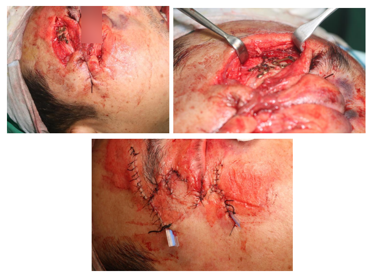57세 남성, 얼굴 전체골절(57/M Panfacial bone fracture) 수술 및 흉터관리 증례 관련 이미지 10