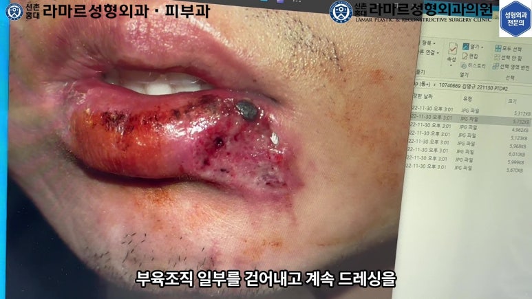 개에 물려 입술 1/3이 뜯긴 19세 남자분 치료 및 흉터 성형수술& 레이저 후기....! 관련 이미지 24
