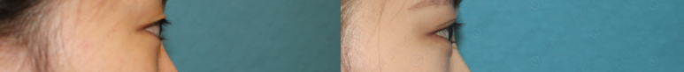 17세 여성, 쌍꺼풀+앞트임(DEO+Medial epicanthoplasty) 관련 이미지 59