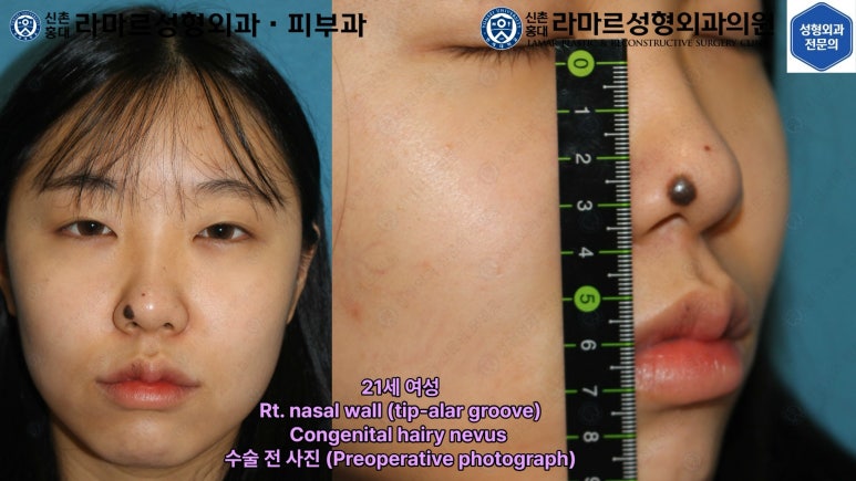 지름 1cm 코 점 제거수술 : 나선피판술(Spiral Flap) 수술전~1달 경과. (Feat. 턱끝필러+사각턱 보톡스) 관련 이미지 34