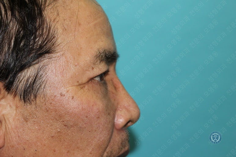 67세 남성, 상&middot;하안검성형술 및 안검하수교정 (67/M, Upper &  lower blepharoplasty with ptosis correction) 관련 이미지 43