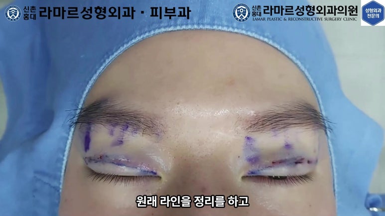 29세 남자, 소시지 쌍꺼풀 두줄따기로 낮추기 (쌍꺼풀 재수술) 관련 이미지 23