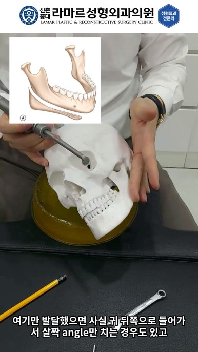 성형수술의 끝판! 성형외과 윤곽수술을 알려드립니다. 저희병원에서 사용하는 수술기구, 그리고 윤곽3종 모의수술....!! 관련 이미지 57
