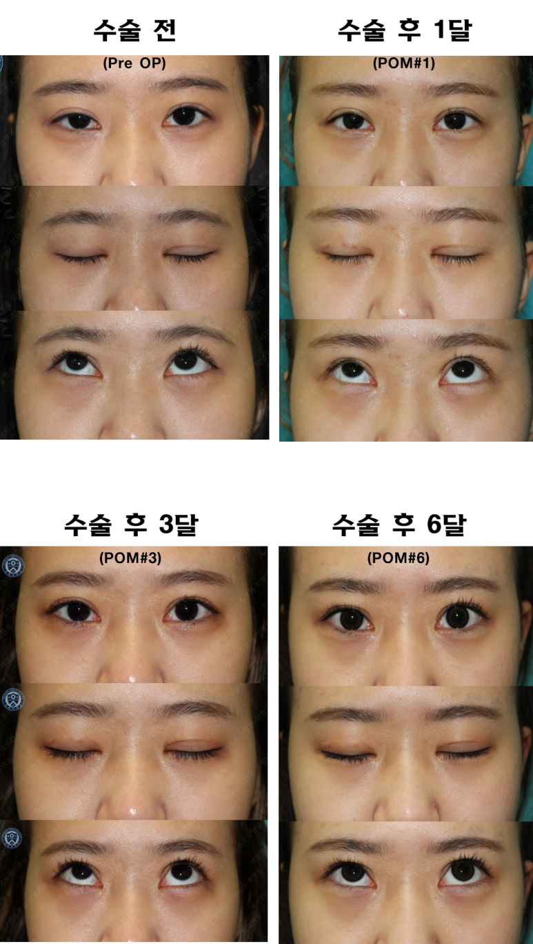 17세 여성, 비절개 눈매교정 및 앞트임 재수술 (17/F NI ptosis correction & Med. epicanthoplasty revision) 증례 관련 이미지 19