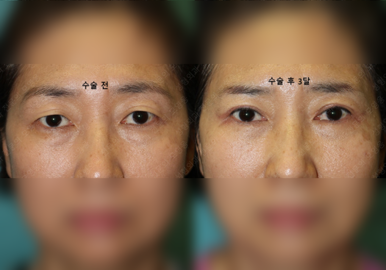 55세 여성, 상안검 및 하안검 성형술 증례 (55/F Upper & lower blepharoplasty) 관련 이미지 30