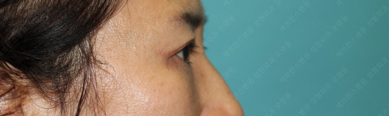 55세 여성, 상안검 및 하안검 성형술 증례 (55/F Upper & lower blepharoplasty) 관련 이미지 26