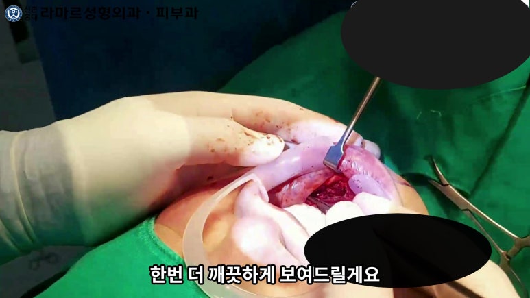 파라핀 필러 입 안 절개로 흉터없이 빼내기! 관련 이미지 65