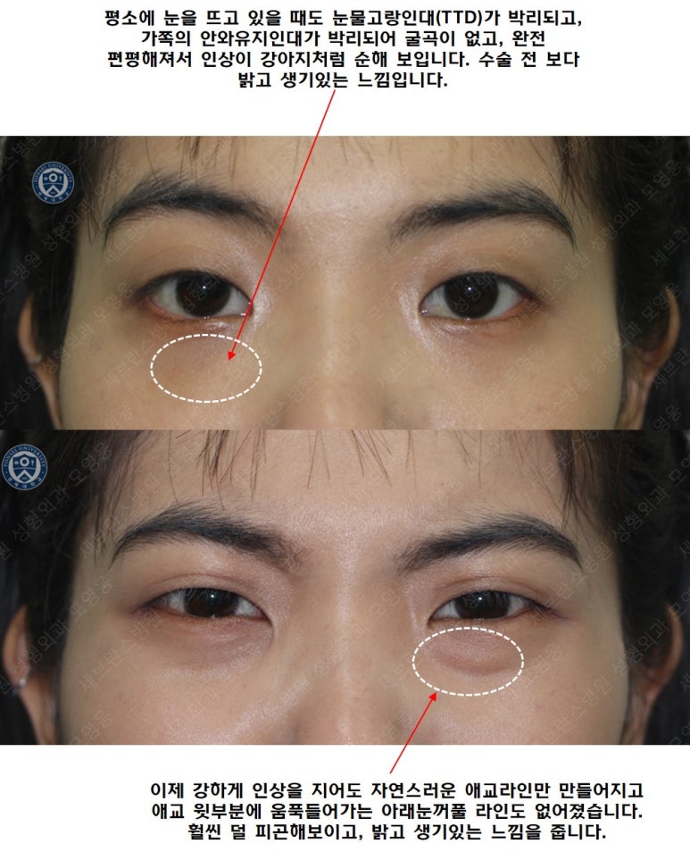 28세 여성, 눈밑지방재배치(눈밑지, 28/F Transconjunctival septal fat redraping-internal fixation technique) 관련 이미지 28