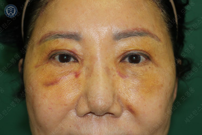 71세 여성, 이마거상술과 이마축소술 (71/F, Forehead lift and reduction) 관련 이미지 21