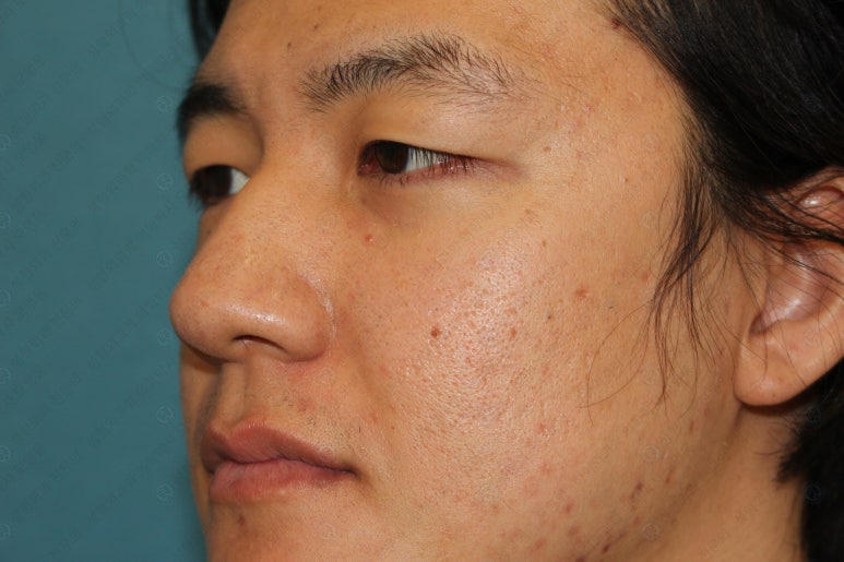 27세 남성 무쌍(속쌍)눈매교정 (27/M Ptosis correction with double lid plasty) 관련 이미지 10