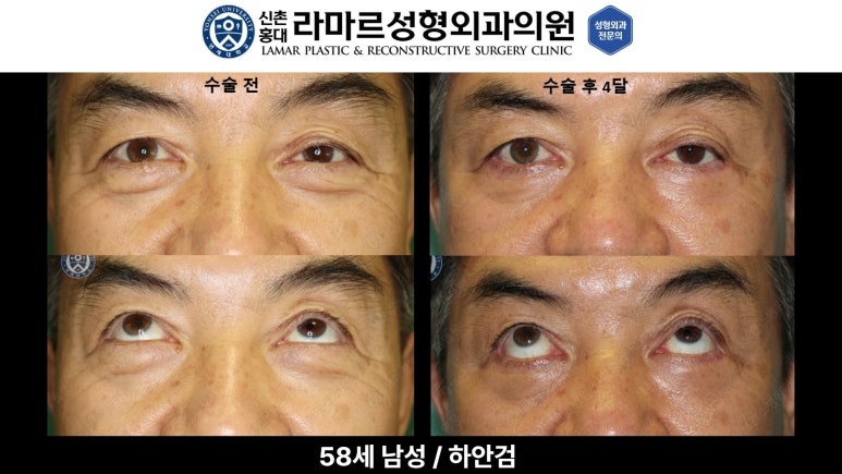 30대~80대 눈 수술 케이스 : 하안검성형술 전후 사진 모음 관련 이미지 52