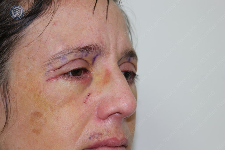 38세 서양 백인 여성, 쌍꺼풀 수술과 눈매교정 및 하안검성형술 (38/F Upper&lower blepharoplasty with levator plication) 관련 이미지 18