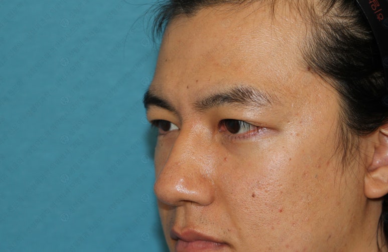 27세 남성 무쌍(속쌍)눈매교정 (27/M Ptosis correction with double lid plasty) 관련 이미지 35