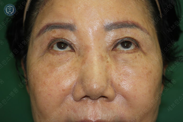 71세 여성, 이마거상술과 이마축소술 (71/F, Forehead lift and reduction) 관련 이미지 32