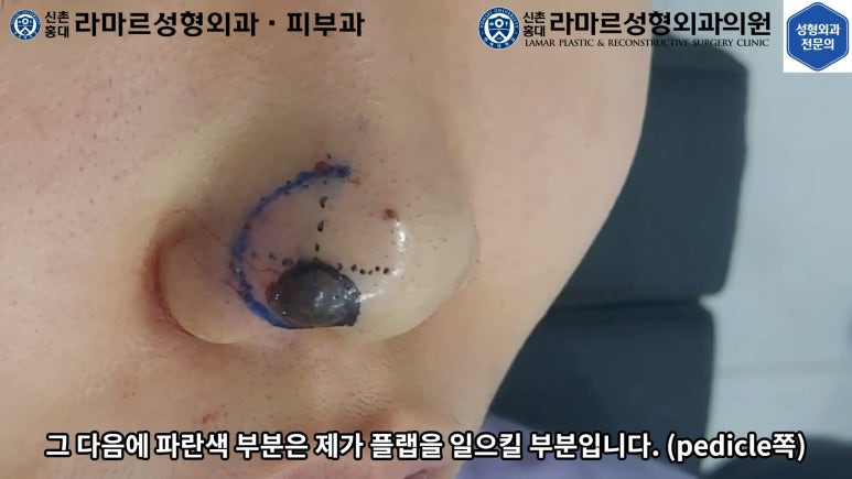 지름 1cm 코 점 제거수술 : 나선피판술(Spiral Flap) 수술전~1달 경과. (Feat. 턱끝필러+사각턱 보톡스) 관련 이미지 52
