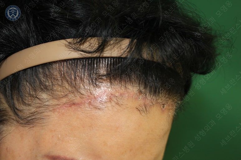 71세 여성, 이마거상술과 이마축소술 (71/F, Forehead lift and reduction) 관련 이미지 38