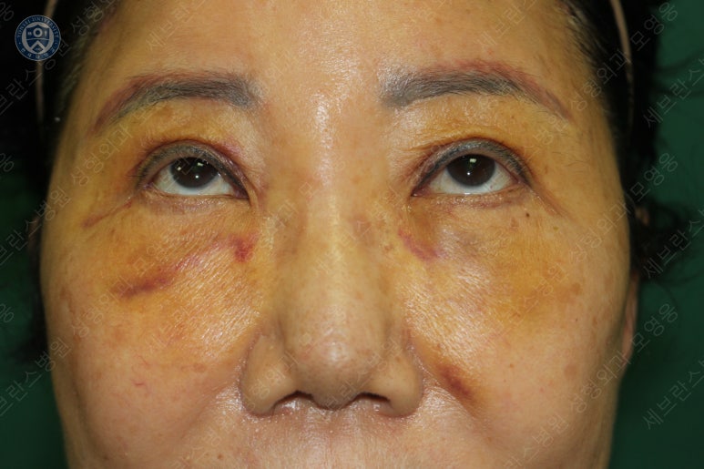 71세 여성, 이마거상술과 이마축소술 (71/F, Forehead lift and reduction) 관련 이미지 23