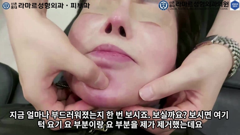 파라핀 필러 입 안 절개로 흉터없이 빼내기! 관련 이미지 105