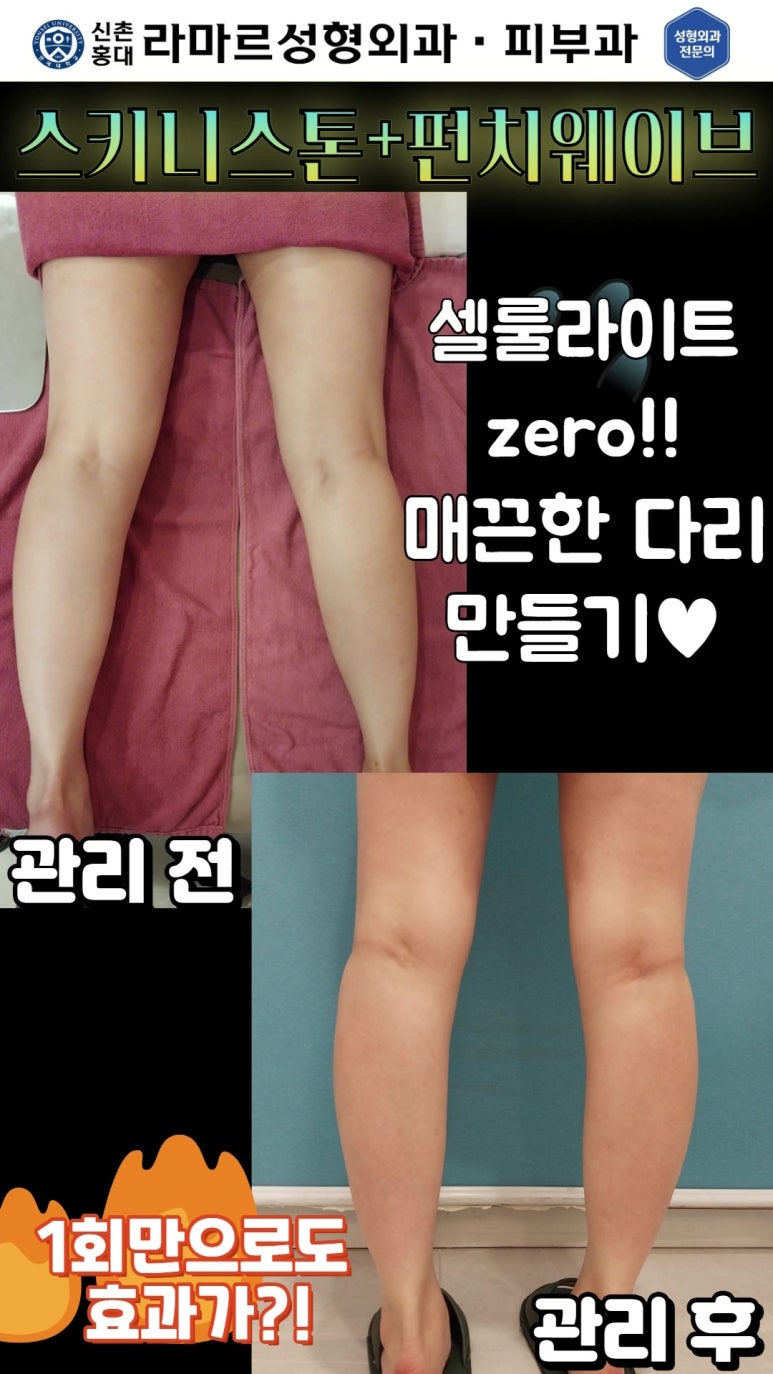 [체형레이저] 얇고 매끈한 다리, 팔, 허리만들기~!! 관련 이미지 5