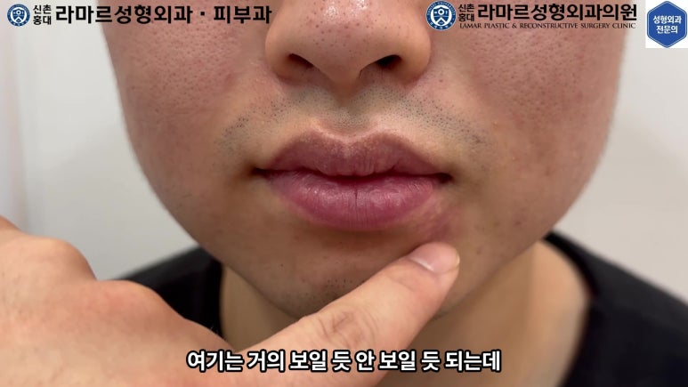 개에 물려 입술 1/3이 뜯긴 19세 남자분 치료 및 흉터 성형수술& 레이저 후기....! 관련 이미지 48