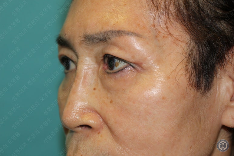 64세 여성 상안검성형술+눈매교정 (64/F Upper blepharoplasty with ptosis correction) 관련 이미지 31